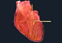 Оземпік та Вегови можуть покращити відновлення після серцевого нападу, відновлюючи кровотік
