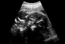 Новые горизонты фетальной хирургии: смогут ли стволовые клетки восстановить спинной мозг при расщеплении позвоночника прямо в утробе?