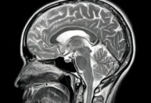 Alzheimermedicijnen werken hier, maar falen daar. Een hersenautopsie legt uit waarom.