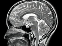 Alzheimermedicijnen werken hier, maar falen daar. Een hersenautopsie legt uit waarom.